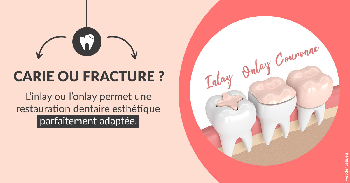 https://dr-charreyron-john.chirurgiens-dentistes.fr/T2 2023 - Carie ou fracture 2