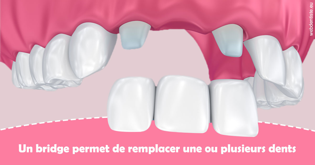 https://dr-charreyron-john.chirurgiens-dentistes.fr/Bridge remplacer dents 2