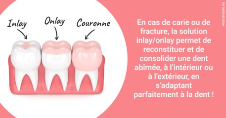 https://dr-charreyron-john.chirurgiens-dentistes.fr/L'INLAY ou l'ONLAY 2