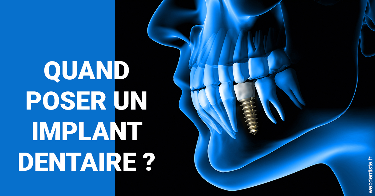 https://dr-charreyron-john.chirurgiens-dentistes.fr/Les implants 1