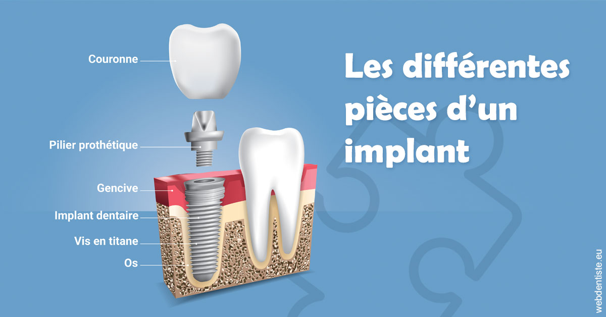 https://dr-charreyron-john.chirurgiens-dentistes.fr/Les différentes pièces d’un implant 1